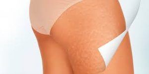 celulitis